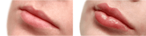 Before-After-Lip-Photo.