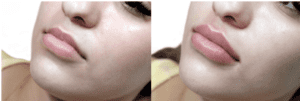 Lip Before & After