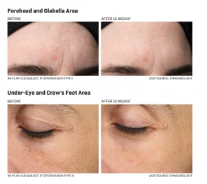 Forehead and Glabella Area