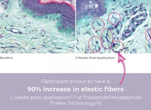The Proof: 90% Increase in Elastic Fibers Production of collagen begins to decline at age 20-25, and production of elastin slows to a trickle by age 40. TriHex Technology® is formulated with Tripeptide-1 and Hexapeptide-12 to support the stimulation of both. See the transformation below the skin’s surface using TriHex Technology®. The deep blue fibers in the photo on the right show brand new elastin fibers underneath the skin’s surface, supported by the application of INhance Post-Injection Serum with TriHex Technology®.